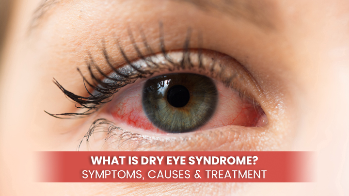 What is Dry Eye Syndrome - Symptoms, Causes & Treatment