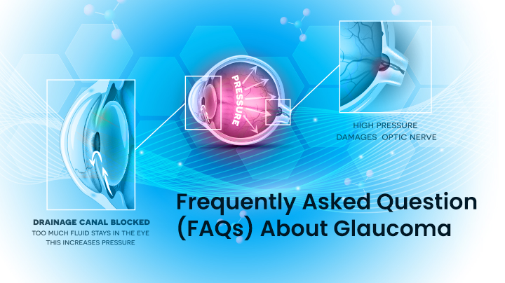 Frequently Asked Question - FAQs About Glaucoma